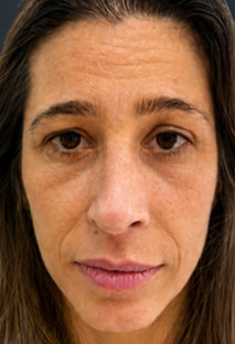Rejuvenescimento facial completo. - Antes