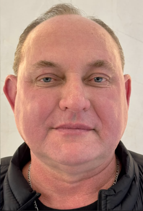 Estruturação facial masculina. - Depois