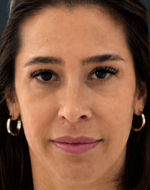 Rejuvenescimento facial completo. - Depois