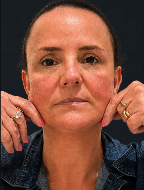 Tratamento de flacidez facial. - Depois