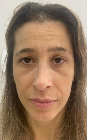 Rejuvenescimento facial completo. - Antes