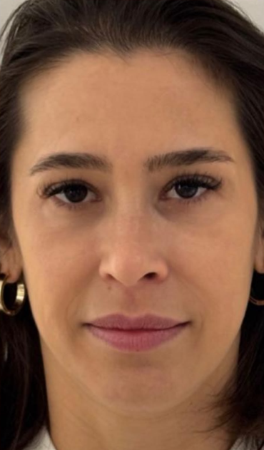 Rejuvenescimento facial completo. - Depois