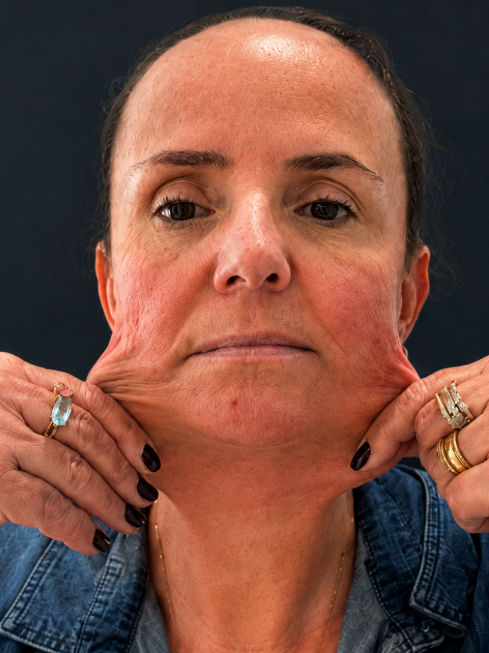 Tratamento de flacidez facial. - Antes